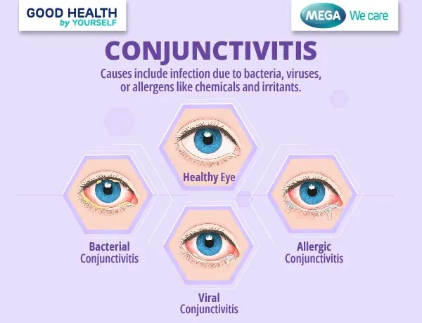 Conjunctivitis