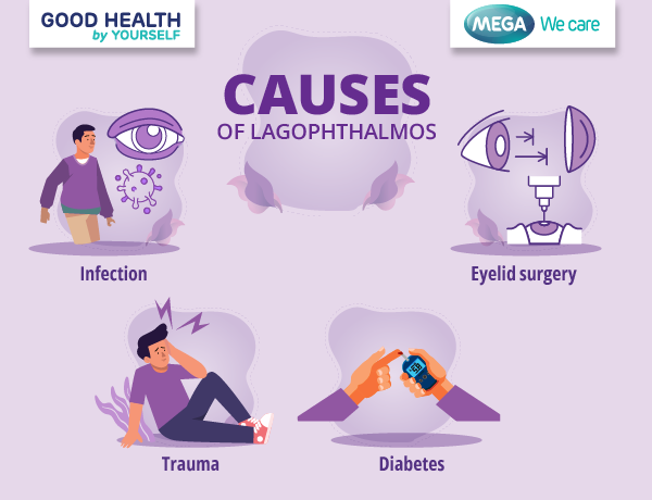 Causes of Lagophthalmos